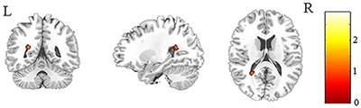 Abnormalities of Cerebral White Matter Microstructure in Children With New-Onset, Untreated Idiopathic-Generalized Epilepsy